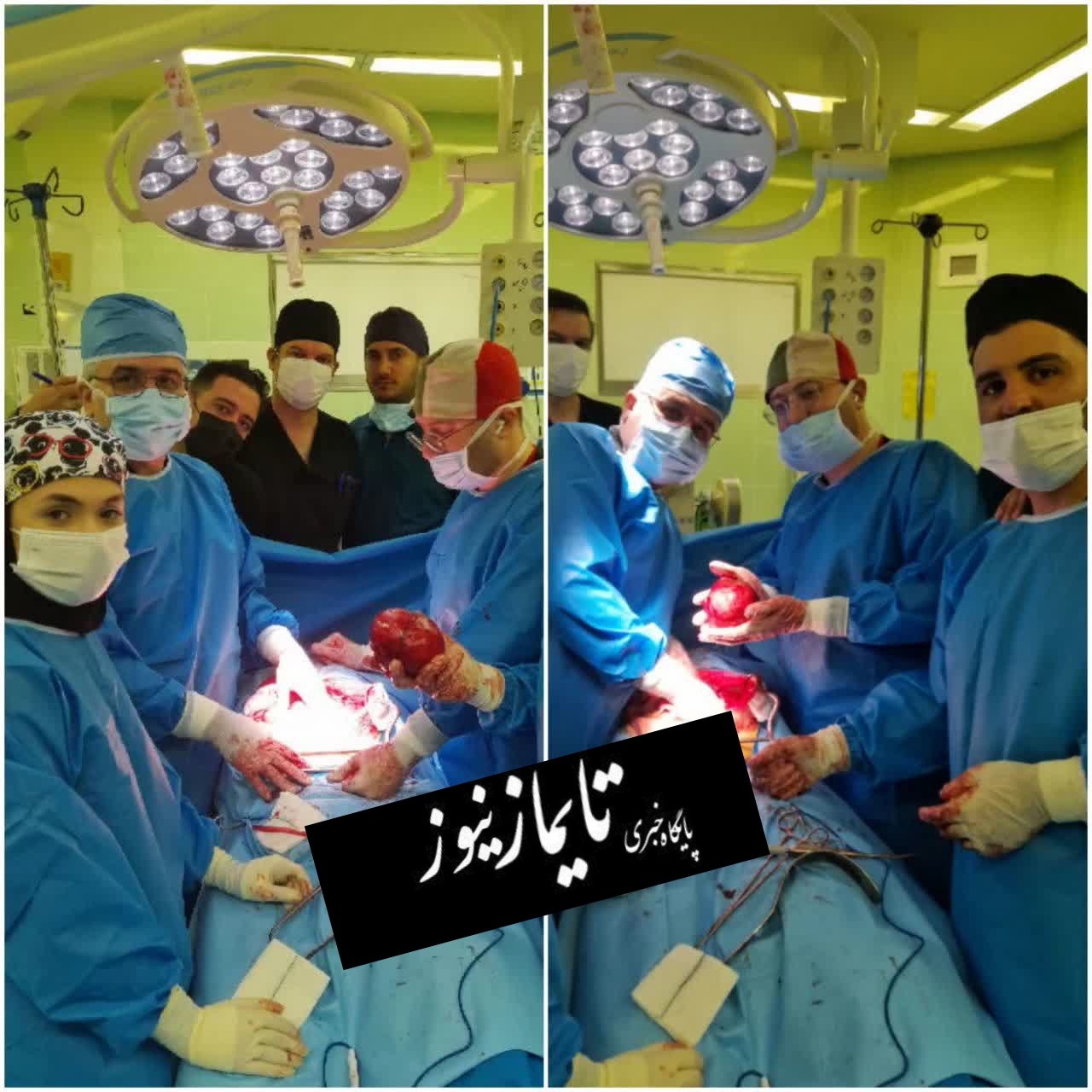  خارج کردن توده ۱/۵ کیلویی از کلیه بیمار ۵۲ ساله در بیمارستان امام رضا (ع) اردبیل